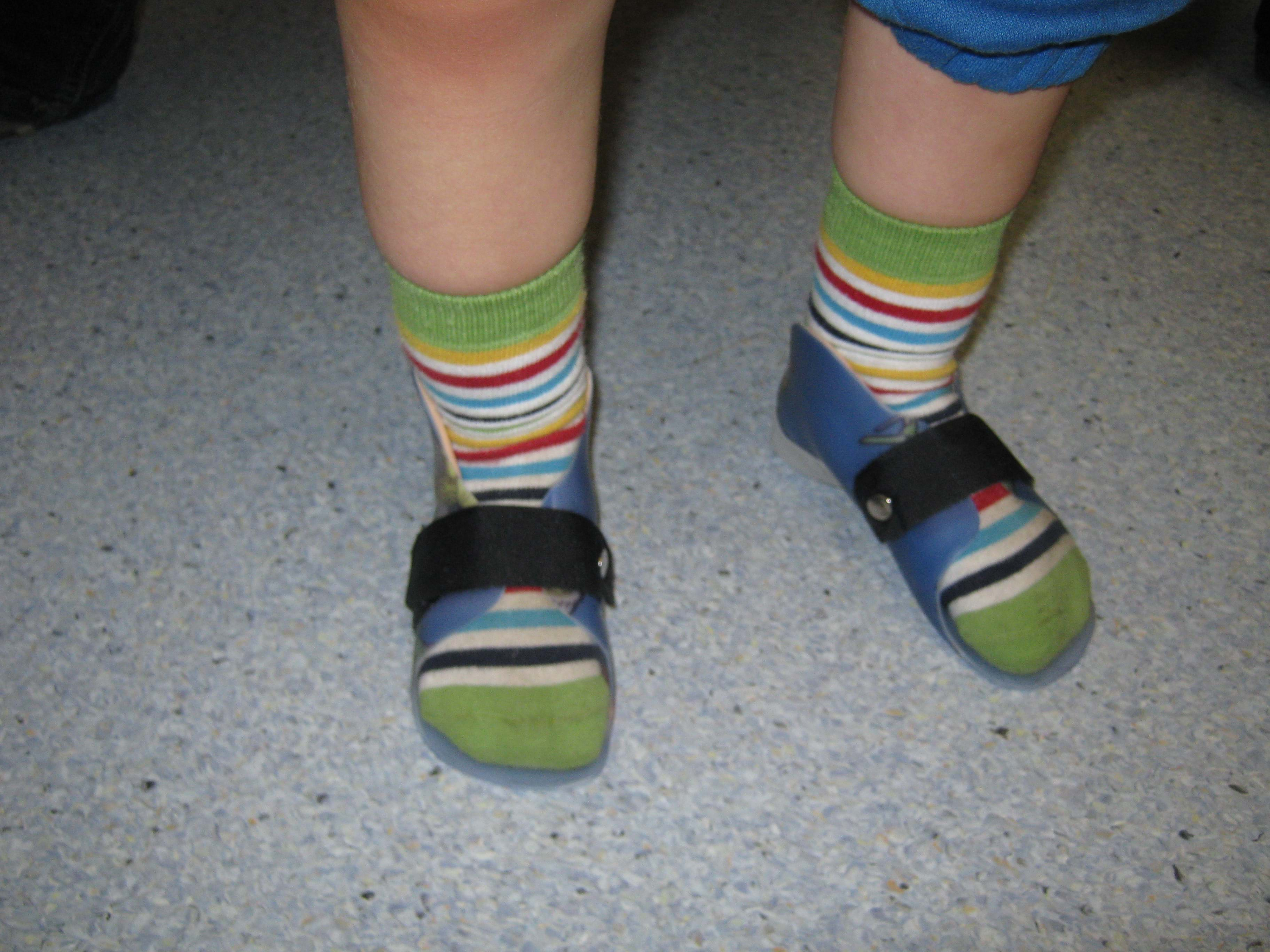 overpronation kids