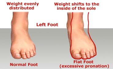 one foot pronates